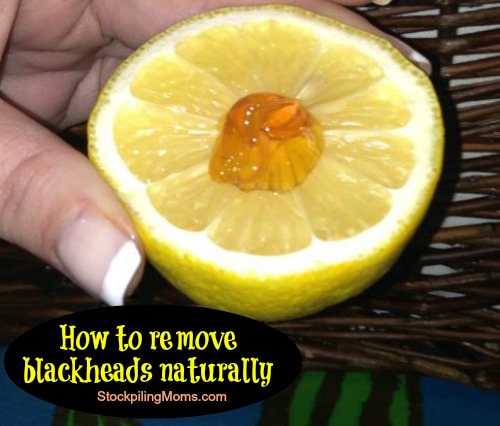 How to remove blackheads naturally